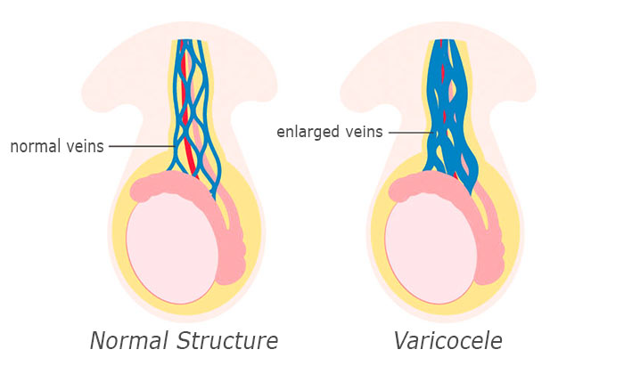 Varicocele — visual overview